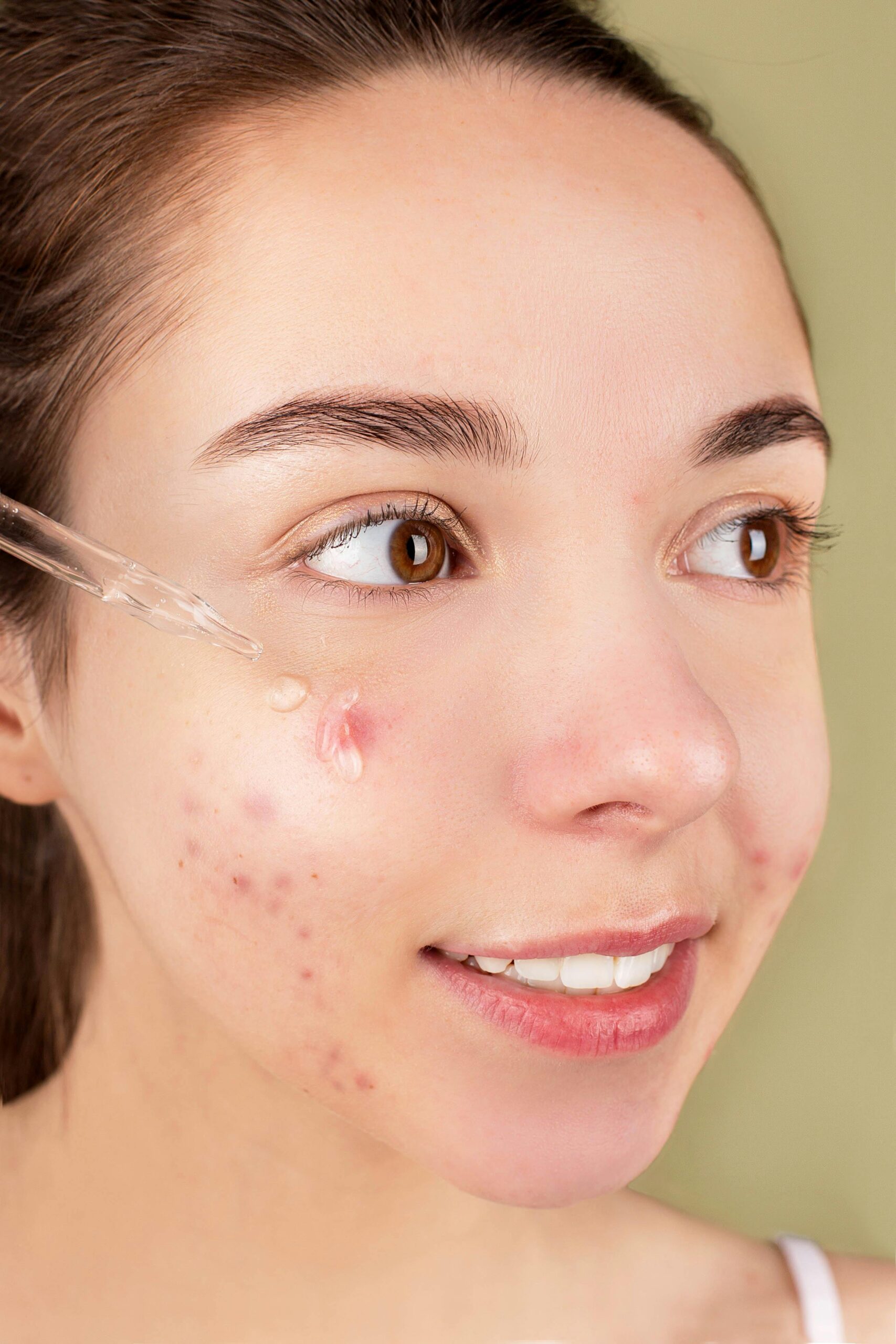 Pimple on Face Removal Tips